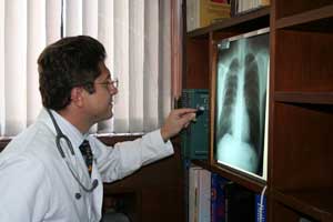 cancer-de-pulmon